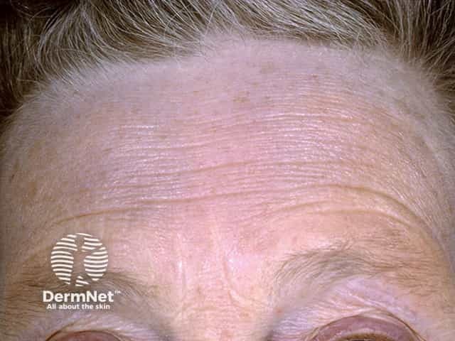 Chrysiasis - blue-grey pigmentation of the forehead due to long-term gold administration for rheumatoid arthritis