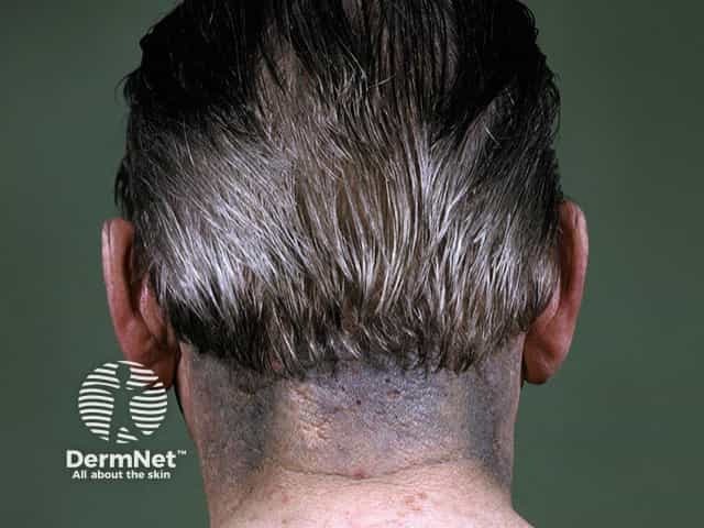 Minocycline-induced pigmentation of the neck