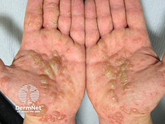 Symmetrical palmar vesicles coalescing into tapioca like blisters in pompholyx eczema