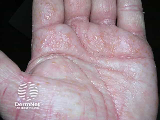 Vesicular pompholyx over the palmar skin