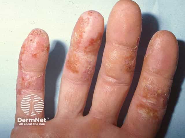 Vesicular eczema on the palmar aspects of the fingers