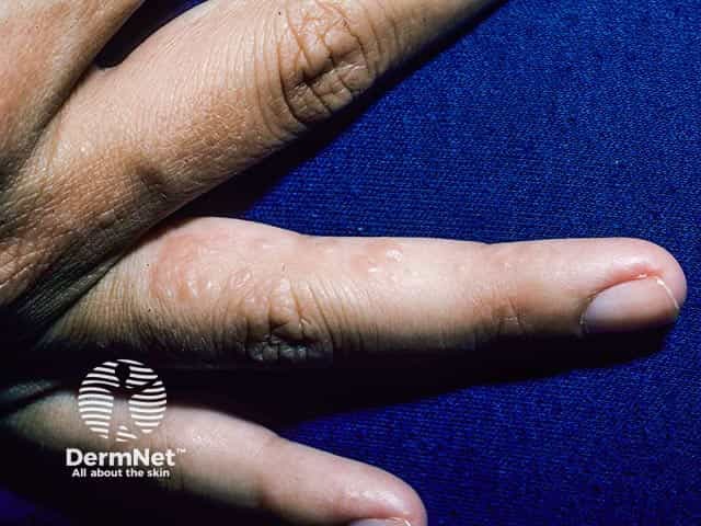 Vesicular eczema on the sides of the fingers