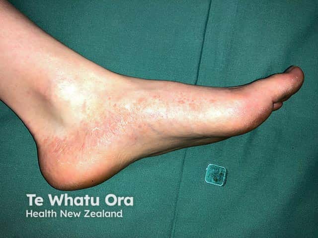 Vesicular eczema on the instep