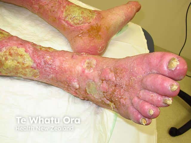 Mixed venous insufficiency and lymphoedema resulting in ulcers, warty hyerkeratosis, and nodular lesions - elephantiasis nostras verrucosa