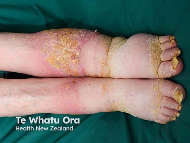 Warty and hyperkeratotic changes arising in chronic lower leg lymphoedema - elephantiasis nostras verrucosa