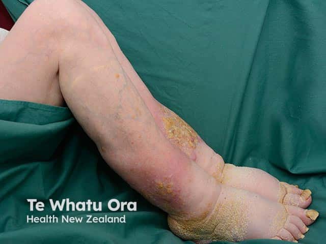 Warty and hyperkeratotic changes arising in chronic lower leg lymphoedema - elephantiasis nostras verrucosa