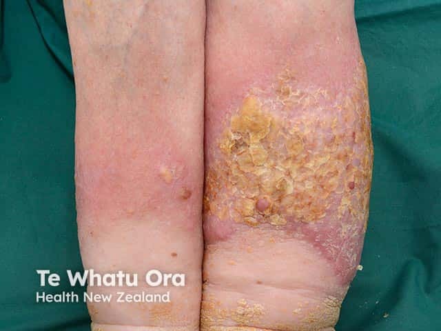 Warty and hyperkeratotic changes arising in chronic lower leg lymphoedema - elephantiasis nostras verrucosa