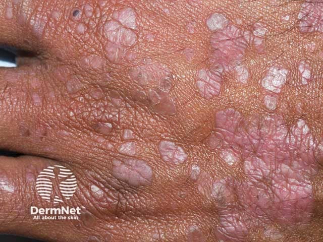 Acquired epidermodysplasia verruciformis in HIV