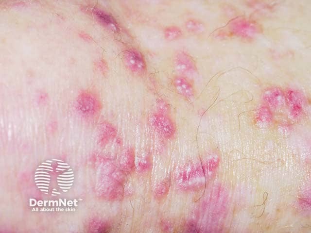 Papules, milia, dyspigmentation