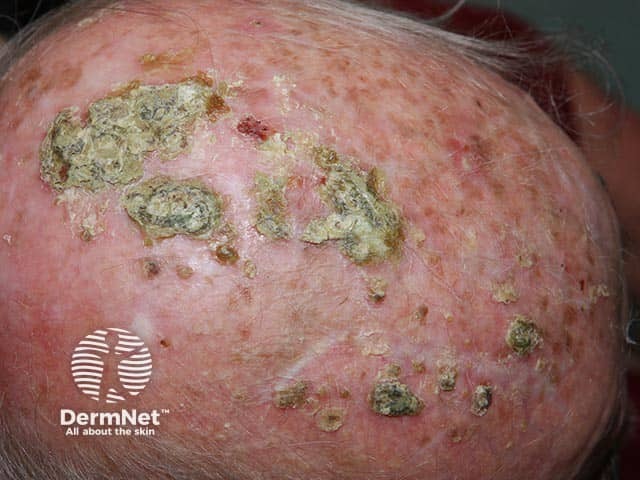 Multiple crusts on a sun-damaged scalp due to erosive pustular dermatosis