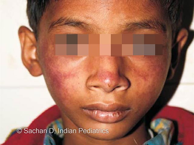 'Slapped cheeks' erythema in skin of colour due to erythema infectiosum