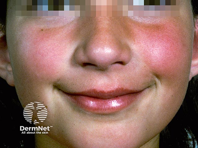 'Slapped cheeks' erythema due to erythema infectiosum