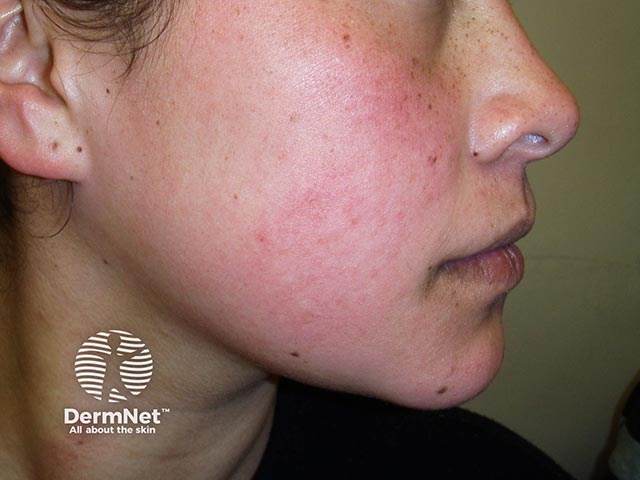 Acute cheek erythema in erythema infectiosum