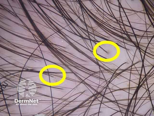 Dermoscopic image showing increased number of single hairs per follicular unit (yellow circles) in the mid-frontal area compared to the occipital area denoting female pattern hair loss.