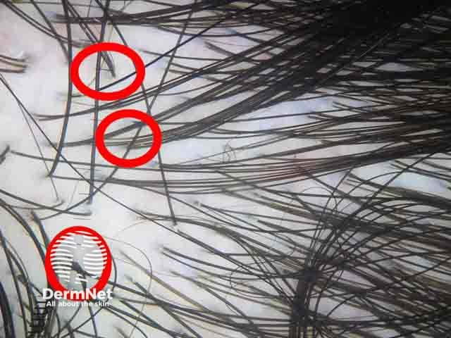 Dermoscopic image showing reduced number of triple hairs (red circles) in the mid-frontal area compared to the occipital area denoting female pattern hair loss.