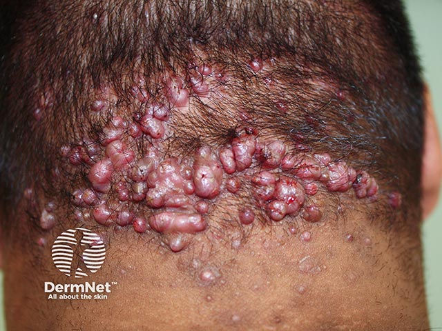 Moderate folliculitis keloidalis nuchae with lesions on the nape of the neck