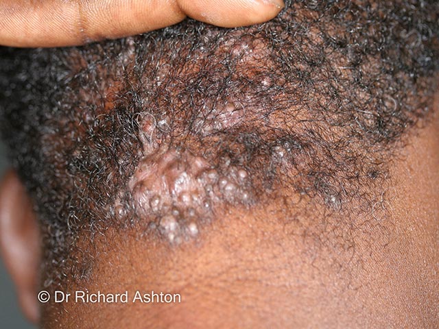 Mild folliculitis keloidalis nuchae with nodules and alopecia