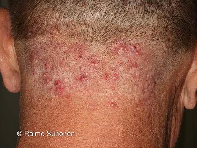 Mild folliculitis keloidalis nuchae