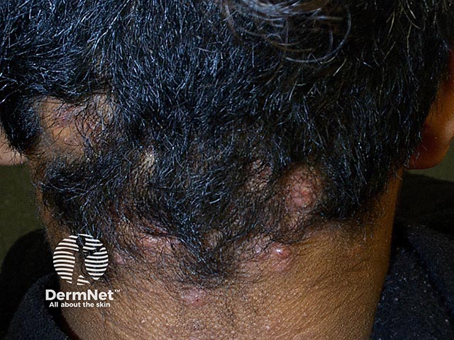 Nodules and alopecia on the nape of the neck, typical of folliculitis keloidalis nuchae