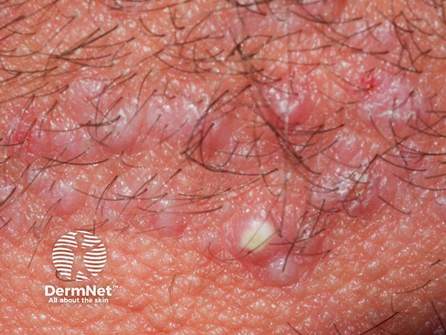 Folliculitis keloidalis nuchae