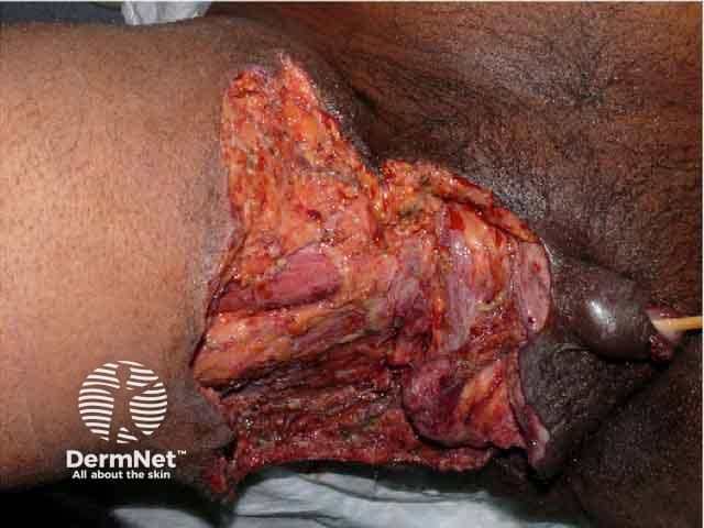 Fournier gangrene after debridement of necrotic tissue