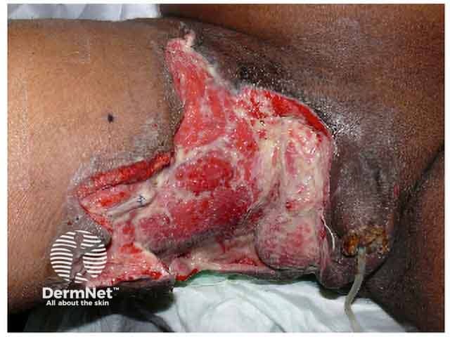 Fournier gangrene after debridement of necrotic tissue