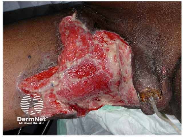 Fournier gangrene after debridement of necrotic tissue