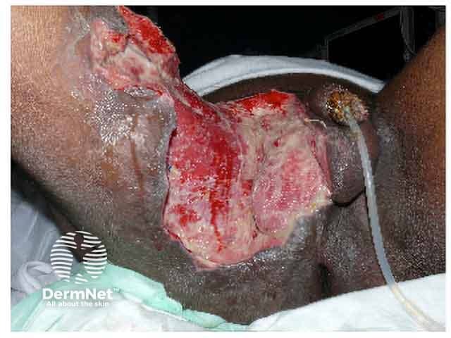 Fournier gangrene after debridement of necrotic tissue