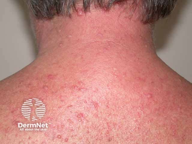 Multiple domed 3-5 mm plugged papules in generalised eruptive keratoacanthomas