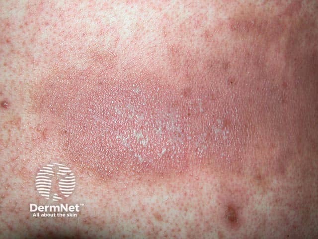 Myriads of small pustules in a patch of pustular psoriasis