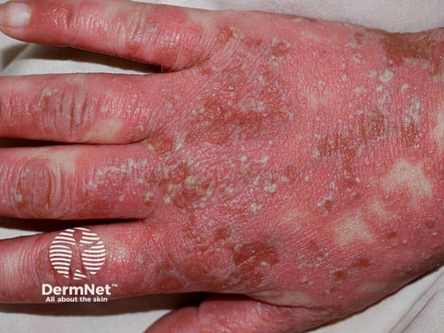 Diffuse erythema studded with superficial pustules in generalised pustular psoriasis