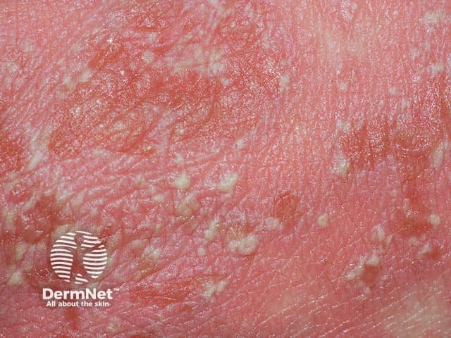 Close up of pustules in generalised pustular psoriasis 