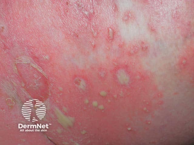 Close up of pustules in generalised pustular psoriasis 