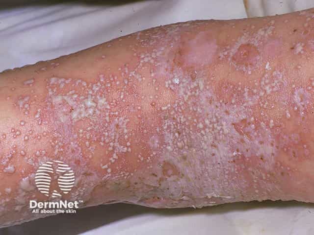 Superficial pustules in generalised pustular psoriasis