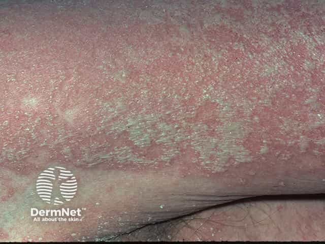 Superficial pustules in generalised pustular psoriasis