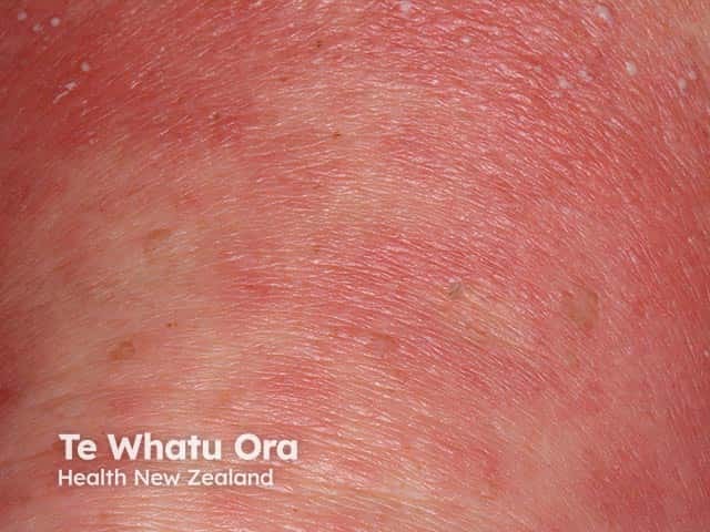 Erythema with some pustules in generalised pustular psoriasis 