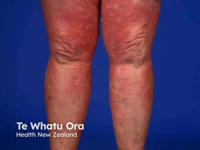 Vivid erythema in generalised pustular psoriasis on the legs