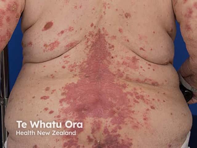 Plaques of generalised pustular psoriasis on the back