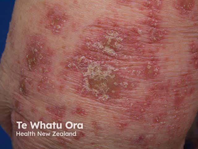 Patches of generalised pustular psoriasis on the arm