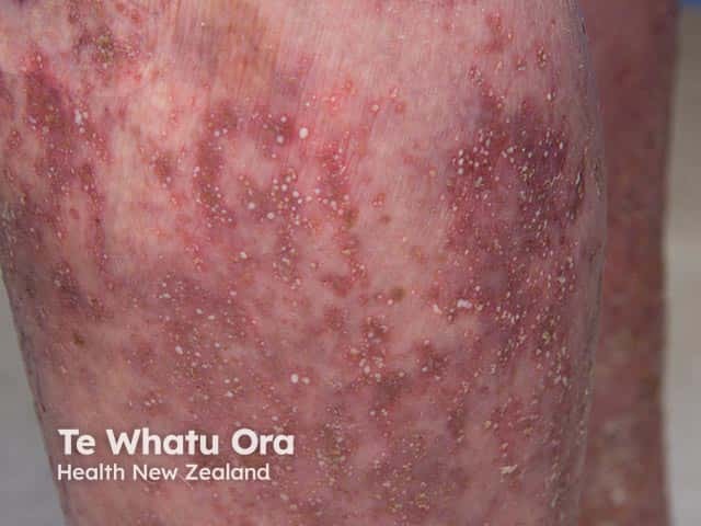 Tiny pustules within erythematous patches on the leg in generalised pustluar psoriasis