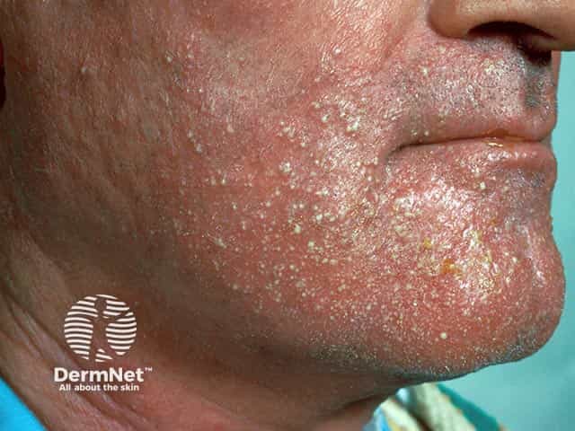 Facial superficial pustules in generalised pustular psoriasis