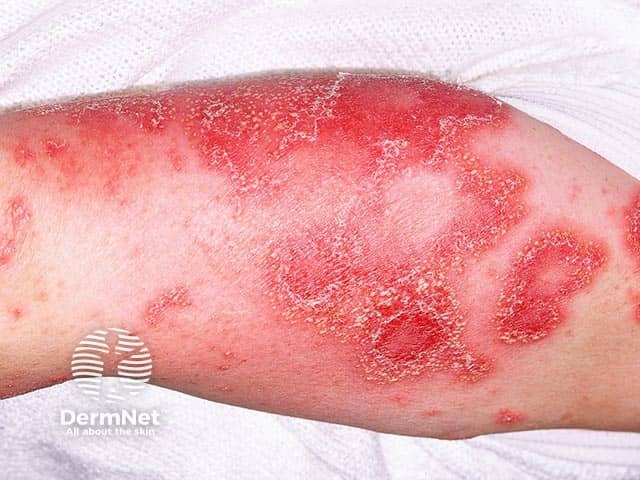 Marginal pustules in generalised pustular psoriasis