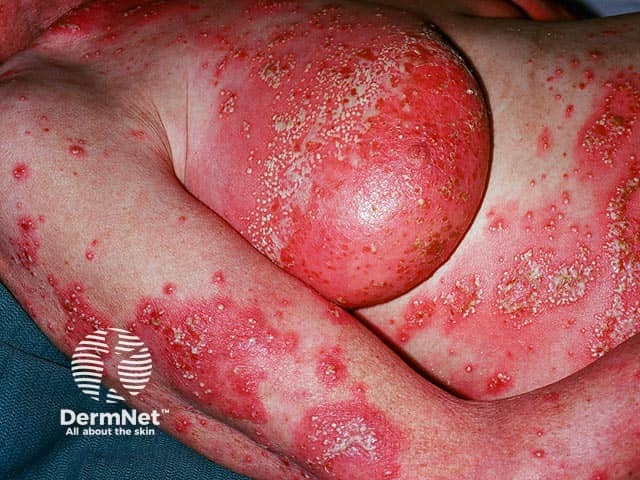 Sheets of pustules on the breasts, abdomen and arms in generalised pustular psoriasis