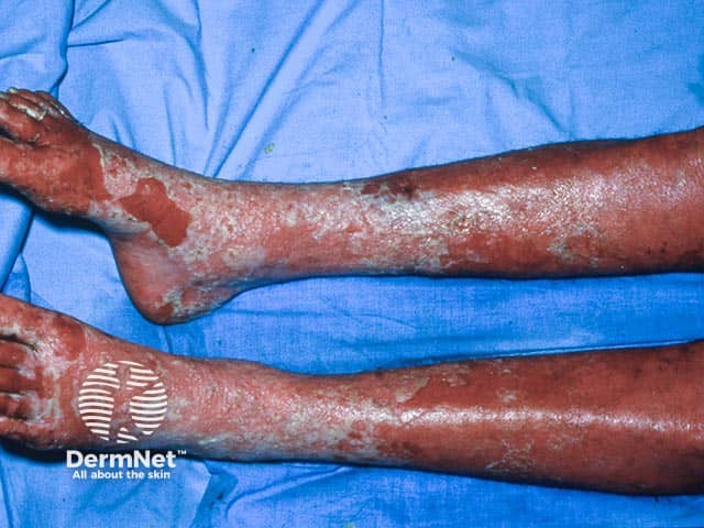 Large lakes of confluent pustules on the legs in erythrodermic generalised pustular psoriasis