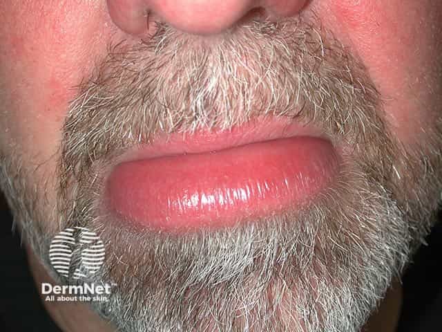 Chronic lower lip swelling due to granulomatous cheilitis