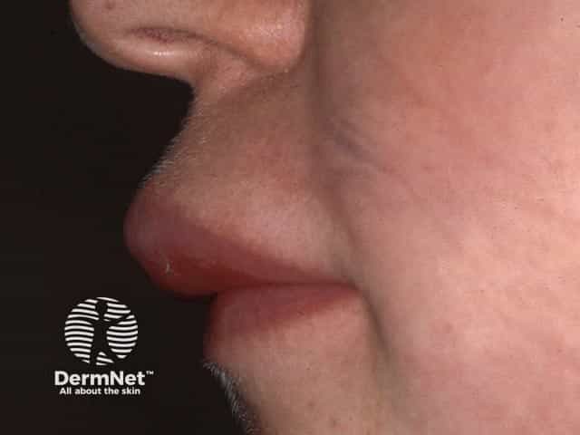 Upper lip swelling and protrusion due to granulomatous cheilitis