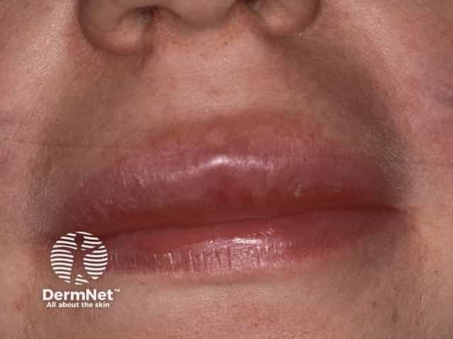 Upper lip swelling due to granulomatous cheilitis