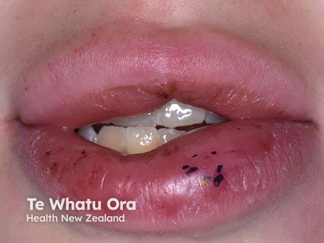 Asymmetric lip swelling due to granulomatous cheilitis