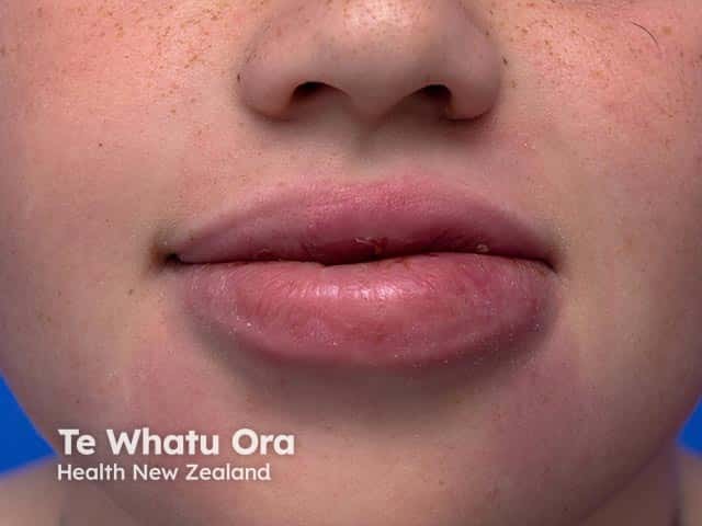 Asymmetric lip swelling due to granulomatous cheilitis