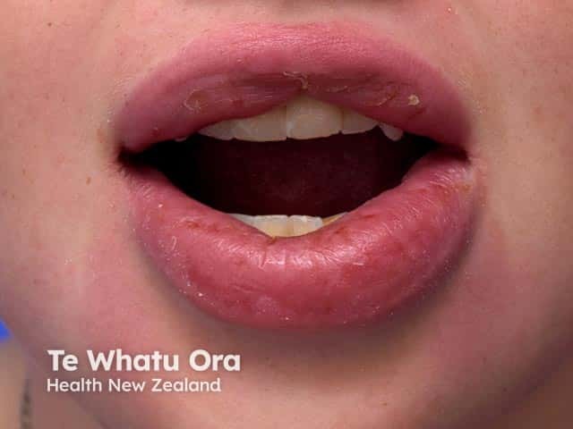 Granulomatous cheilitis with underlying Crohn disease